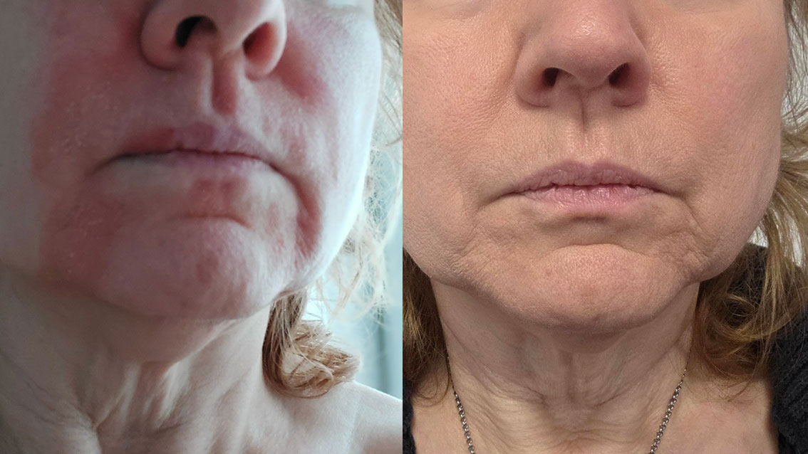 Beispiel Vorher-Nachher: Rosazea mit Ekzem