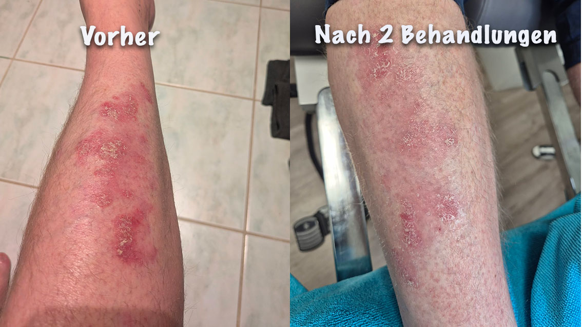 Kaltes Plasma Anwendung Beispiel 2 vorher nachher bei Psoriasis